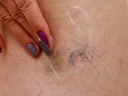 Zbavte se křečových žil jednou provždy přirozenou cestou – naše babičky už toto tajemství znali!