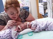 Siamská dvojčata se narodila se srostlými hlavami, ale lékaři je dokázali oddělit a takhle vypadají
