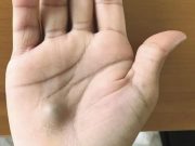 Pokud po návštěvě zubaře uvidíte takovou bulku na ruce – Okamžitě zavolejte záchrannou službu!