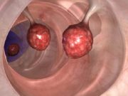 Smrt začíná v tlustém střevě, říká doktor nositel Nobelovy ceny!