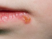 Horečka na rtu: Vše, co potřebujete vědět o HERPES