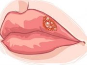 Udělal se vám opar na rtech? Udělejte to dnes večer, HERPES ZMIZÍ V REKORDNÍM ČASE