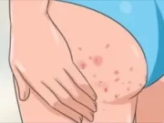 Příčiny akné na hýždích u žen a domácí léčba