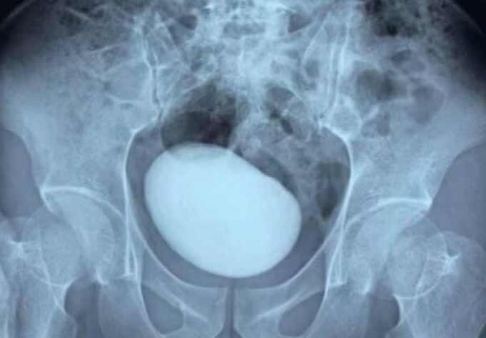 6007061b-03ac-4e18-9564-044c0a0a0a64-giant-bladder-stone5-e1611046551405-690x480-1.jpg.pagespeed.ce_.PMLEu_3xek