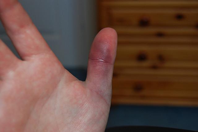 finger-injury-is-a-minor_1