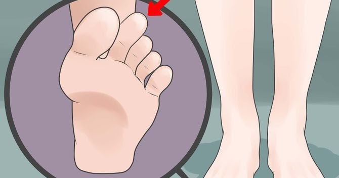 670px-Deal-With-Morton's-Toe-Step-1-Version-2 (1)