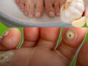 BOLESTIVÉ KUŘÍ OKO ZMIZÍ PŘES NOC? Lékaři mlčí, ale TATO KUCHYŇSKÁ SMĚS s česnekem a octem je prý ZÁCHRANA! (Už žádné řezy!)